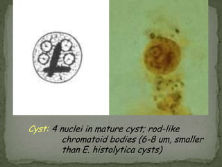 Gross pathology of amebic abscess of liver. Tube of "chocolate" pus from abscess.