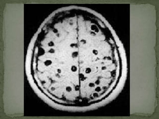 Causal Agent:The nematode (roundworm) Strongyloidesstercoralis.  Other Strongyloides include S. fülleborni, which infects chimpanzees and baboons and may produce limited infections in humans..Geographic Distribution:Tropical and subtropical areas, but cases also occur in temperate areas (including the South of the United States).  More frequently found in rural areas, institutional settings, and lower socioeconomic groups