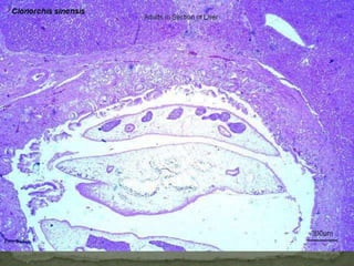 Eggs of Diphyllobothrium latum:are oval or ellipsoidal, with at one end an operculum (arrows) that can be inconspicuous.  The eggs are passed in the stool unembryonated. 