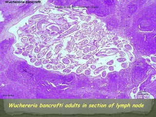 Taenia saginataIngestion of raw or poorly cooked beefCows infected via the ingestion of human waste containing the eggs of the parasiteCows contain viable cysticercus larvae in the muscleHumans act as the host only to the adult tapewormsUp to 25 meters in the lumen of intestineFound all over the world, including the U.S.