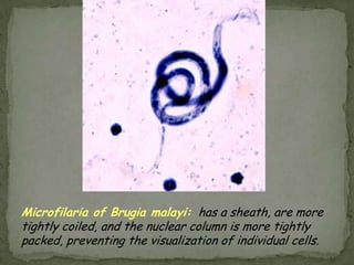 CysticercosisClinical manifestationsAdult worms rarely cause sxsLarvae penetrate intestine, enter blood, and eventually encyst in the brain.Cerebral ventircles  hydrocephalusSpinal cord  compression, paraplegiaSubarachnoid space  chronic meningitisCerebral cortex  seizuresCysts may remain asymptomatic for years, and become clinically apparent when larvae dieLarvae may encyst in other organs, but are rarely symptomatic