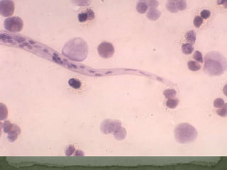 Causal Agents:Schistosomiasis is caused by digenetic blood trematodes.  The three main species infecting humans are Schistosomahaematobium, S. japonicum, and S. mansoni.  In addition, other species of schistosomes, which parasitize birds and mammals, can cause cercarial dermatitis in humans.Geographic Distribution: Schistosomamansoni is found in parts of South America and the Caribbean, Africa, and the Middle East; S. haematobium in Africa and the Middle East; and S. japonicum in the Far East. 