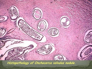 Source of infection: eating watercress, lettuce or radishes or drinking water infested with metacercariae