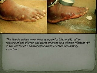 Causal Agents:The trematodesFasciola hepatica (the sheep liver fluke) and Fasciolagigantica, parasites of herbivores that can infect humans accidentally.Geographic Distribution:Fascioliasis occurs worldwide.  Human infections with F. hepatica are found in areas where sheep and cattle are raised, and where humans consume raw watercress, including Europe, the Middle East, and Asia.  Infections with F. gigantica have been reported, more rarely, in Asia, Africa, and Hawaii.