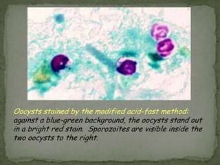 Cryptosporidium parvumDisease: Cryptosporidiosis