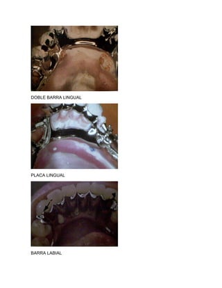 DOBLE BARRA LINGUAL




PLACA LINGUAL




BARRA LABIAL
 