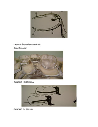 La gama de ganchos puede ser:
Circunferencial




GANCHO HORQUILLA




GANCHO EN ANILLO
 