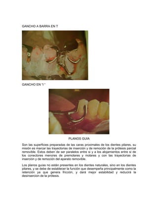 GANCHO A BARRA EN T




GANCHO EN “I “




                                 PLANOS GUIA
Son las superficies preparadas de las caras proximales de los dientes pilares, su
misión es marcar las trayectorias de inserción y de remoción de la prótesis parcial
removible. Estos deben de ser paralelos entre si y a los alojamientos entre si de
los conectores menores de premolares y molares y con las trayectorias de
inserción y de remoción del aparato removible.
Los planos guías no están presentes en los dientes naturales, sino en los dientes
pilares, y se debe de establecer la función que desempeña principalmente como la
retención ya que genera fricción, y dará mejor estabilidad y reducirá la
desinsercion de la prótesis.
 