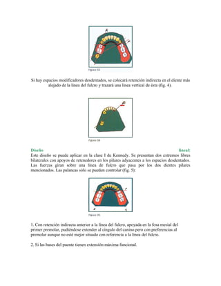 Si hay espacios modificadores desdentados, se colocará retención indirecta en el diente más
          alejado de la línea del fulcro y trazará una línea vertical de ésta (fig. 4).




Diseño                                                                              lineal:
Este diseño se puede aplicar en la clase I de Kennedy. Se presentan dos extremos libres
bilaterales con apoyos de retenedores en los pilares adyacentes a los espacios desdentados.
Las fuerzas giran sobre una línea de fulcro que pasa por los dos dientes pilares
mencionados. Las palancas sólo se pueden controlar (fig. 5):




1. Con retención indirecta anterior a la línea del fulcro, apoyada en la fosa mesial del
primer premolar, pudiéndose extender al cíngulo del canino pero con preferencias al
premolar aunque no esté mejor situado con referencia a la línea del fulcro.

2. Si las bases del puente tienen extensión máxima funcional.
 