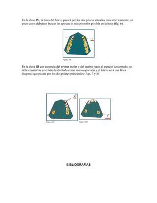 En la clase IV, la línea del fulcro pasará por los dos pilares situados más anteriormente, en
estos casos debemos buscar los apoyos lo más posterior posible en la boca (fig. 6).




En la clase III con ausencia del primer molar y del canino junto al espacio desdentado, se
debe considerar este lado desdentado como mucosoportado y el fulcro será una línea
diagonal que pasará por los dos pilares principales (figs. 7 y 8).




                                     BIBLIOGRAFIAS
 