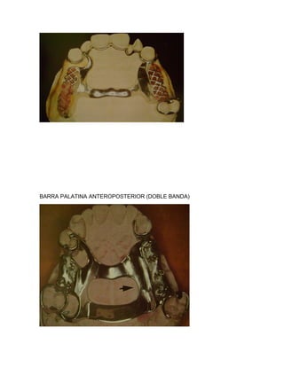 BARRA PALATINA ANTEROPOSTERIOR (DOBLE BANDA)
 