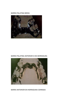 BARRA PALATINA MEDIA




BARRA PALATINA ANTERIOR O EN HERRADURA




BARRA ANTERIOR EN HERRADURA CERRADA
 