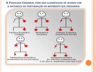 A PARALISIA CEREBRAL PODE SER CLASSIFICADA DE ACORDO COM
 A NATUREZA DA PERTURBAÇÃO DO MOVIMENTO QUE PREDOMINA:
 