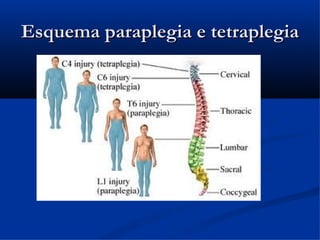 Esquema paraplegia e tetraplegia
 