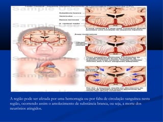 A região pode ser afetada por uma hemorragia ou por falta de circulação sanguínea nesta
região, ocorrendo assim o amolecimento de substância branca, ou seja, a morte dos
neurônios atingidos.
 