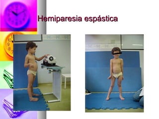 HHeemmiippaarreessiiaa eessppáássttiiccaa 
 