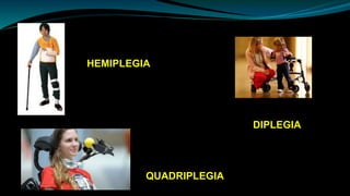 HEMIPLEGIA
DIPLEGIA
QUADRIPLEGIA
 