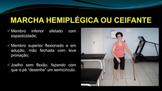 MARCHA HEMIPLÉGICA OU CEIFANTE
 Membro inferior afetado com
espasticidade;
 Membro superior flexionado e em
adução, mão fechada com leve
pronação;
 Joelho sem flexão, fazendo com
que o pé “desenhe” um semicírculo.
 