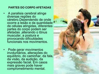 PARTES DO CORPO AFETADAS
• A paralisia cerebral atinge
diversas regiões do
cérebro.Dependendo de onde
ocorre a lesão e da quantidade
de células atingidas, diferentes
partes do corpo podem ser
afetadas ,alterando o tônus
muscular, a postura e
provocando dificuldades
funcionais nos movimentos.
• Pode gerar movimentos
involuntários, alterações do
equilíbrio, do caminhar, da fala,
da visão, da audição, da
expressão facial. Em casos
mais graves pode haver
comprometimento mental.
 