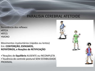 Persistência dos reflexos:
•RTCA
•RTCS
•MORO
Movimentos involuntários (rápidos ou lentos)
Em: CONTORÇÃO, ESPASMOS,
ROTATÓRIOS, e Reações de RETIFICAÇÃO
Reações de Equilíbrio AUSENTE ou INCOMPLETA
Ausência de controle postural SEM ESTABILIDADE
PROXIMAL
PARALISIA CEREBRAL ATETOIDE
 