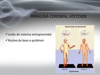 PARALISIA CEREBRAL ATETOIDE
Lesão do sistema extrapiramidal
Núcleo da base e putâmen
 