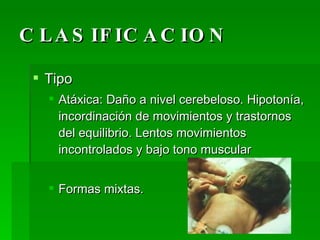 CLASIFICACION Tipo Atáxica: Daño a nivel cerebeloso. Hipotonía, incordinación de movimientos y trastornos del equilibrio. Lentos movimientos incontrolados y bajo tono muscular Formas mixtas.  