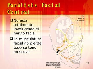 paralisis Facial | PPT