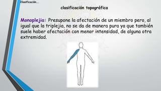 clasificación topográfica
Monoplejia: Presupone la afectación de un miembro pero, al
igual que la triplejia, no se da de manera pura ya que también
suele haber afectación con menor intensidad, de alguna otra
extremidad.
Clasificación….
 