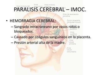 PARALISIS CEREBRAL – IMOC.
• HEMORRAGIA CEREBRAL:
  – Sangrado intracraneano por vasos rotos o
    bloqueados.
  – Causado por coágulos sanguíneos en la placenta.
  – Presión arterial alta de la madre.
 