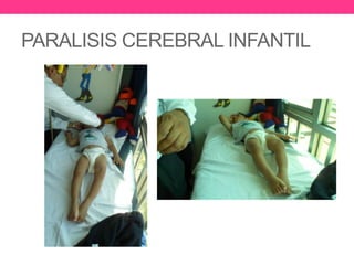 PARALISIS CEREBRAL INFANTIL

 