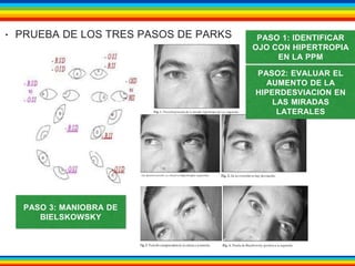 ‣ PRUEBA DE LOS TRES PASOS DE PARKS PASO 1: IDENTIFICAR 
OJO CON HIPERTROPIA 
EN LA PPM 
PASO2: EVALUAR EL 
AUMENTO DE LA 
HIPERDESVIACION EN 
LAS MIRADAS 
LATERALES 
PASO 3: MANIOBRA DE 
BIELSKOWSKY 
 