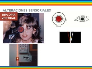 ALTERACIONES SENSORIALES 
DIPLOPIA 
VERTICAL 
 