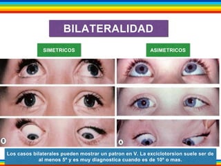 BILATERALIDAD 
SIMETRICOS ASIMETRICOS 
Los casos bilaterales pueden mostrar un patron en V. La exciclotorsion suele ser de 
al menos 5º y es muy diagnostica cuando es de 10º o mas. 
 