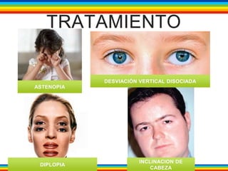 TRATAMIENTO 
ASTENOPIA 
DESVIACIÓN VERTICAL DISOCIADA 
DIPLOPIA 
INCLINACION DE 
CABEZA 
 