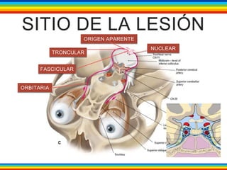 SITIO DE LA LESIÓN 
NUCLEAR 
ORIGEN APARENTE 
TRONCULAR 
FASCICULAR 
ORBITARIA 
 