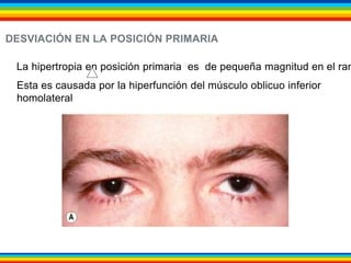 DESVIACIÓN EN LA POSICIÓN PRIMARIA 
La hipertropia en posición primaria es de pequeña magnitud en el rango Esta es causada por la hiperfunción del músculo oblicuo inferior 
homolateral 
 