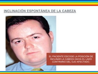 INCLINACIÓN ESPONTÁNEA DE LA CABEZA 
EL PACIENTE ESCOGE LA POSICIÓN DE 
INCLINAR LA CABEZA HACIA EL LADO 
CONTRARIO DEL OJO AFECTADO. 
 