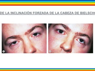 DE LA INCLINACIÓN FORZADA DE LA CABEZA DE BIELSCHOWSKY. 
 