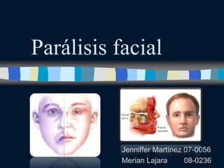 Parálisis facial 
Jenniffer Martínez 07-0056 
Merian Lajara 08-0236 
 