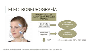 ELECTRONEUROGRAFÍA
MIDE POTENCIAL DE
ACCIÓN DE LOS MÚSCULOS
FACIALES
Electrodo
estimulante
Foramen
estilomastoid
eo
Electrodo
medidor
Pliegue
nasolabial
CAP degeneración de fibras nerviosas
Flint, Paul W., Haughey BH, Thomas JR, et. al. Cummings Otolaryngology Head and Neck Surgery. 7ª ed. St. Louis: Mosby, 2021.
 