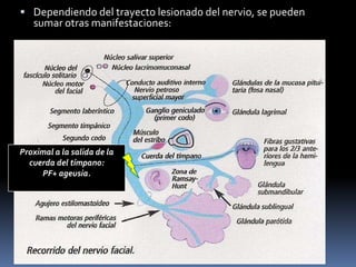  Dependiendo del trayecto lesionado del nervio, se pueden
   sumar otras manifestaciones:




Proximal a la salida de la
  cuerda del tímpano:
     PF+ ageusia.
 
