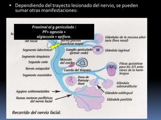  Dependiendo del trayecto lesionado del nervio, se pueden
  sumar otras manifestaciones:


          Proximal al g.geniculado :
                PF+ ageusia +
             algiacusia + epífora.
 