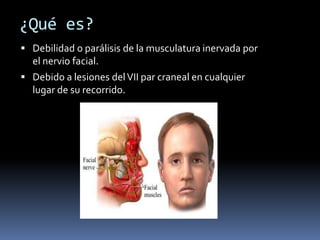 ¿Qué es?
 Debilidad o parálisis de la musculatura inervada por
  el nervio facial.
 Debido a lesiones del VII par craneal en cualquier
  lugar de su recorrido.
 