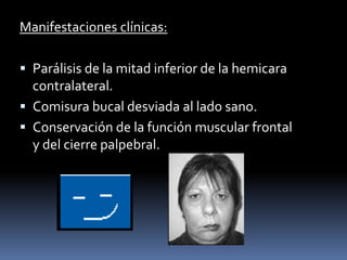Manifestaciones clínicas:

 Parálisis de la mitad inferior de la hemicara
  contralateral.
 Comisura bucal desviada al lado sano.
 Conservación de la función muscular frontal
  y del cierre palpebral.
 