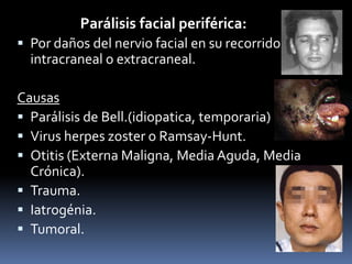 Parálisis facial periférica:
 Por daños del nervio facial en su recorrido
  intracraneal o extracraneal.

Causas
 Parálisis de Bell.(idiopatica, temporaria)
 Virus herpes zoster o Ramsay-Hunt.
 Otitis (Externa Maligna, Media Aguda, Media
  Crónica).
 Trauma.
 Iatrogénia.
 Tumoral.
 