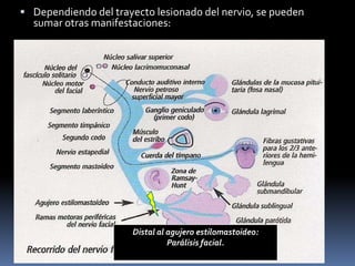  Dependiendo del trayecto lesionado del nervio, se pueden
  sumar otras manifestaciones:




                      Distal al agujero estilomastoideo:
                                Parálisis facial.
 