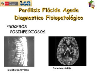 Parálisis Flácida Aguda Diagnostico Fisiopatológico PROCESOS POSINFECCIOSOS Mielitis transversa Encefalomielitis 