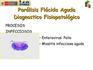 Parálisis Flácida Aguda Diagnostico Fisiopatológico PROCESOS INFECCIOSOS Enterovirus: Polio Miositis infecciosa aguda 