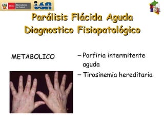 Parálisis Flácida Aguda Diagnostico Fisiopatológico METABOLICO Porfiria intermitente aguda Tirosinemia hereditaria 