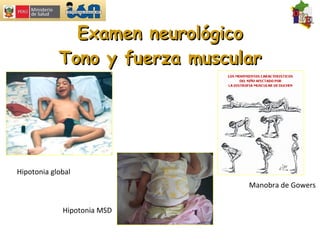 Examen neurológico Tono y fuerza muscular Hipotonia global Hipotonia MSD Manobra de Gowers 